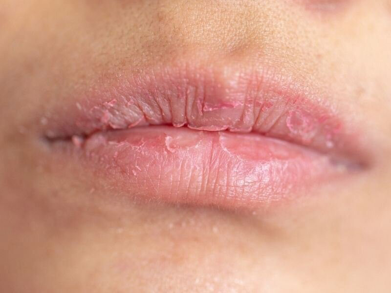 dudak-çatlaması (10)