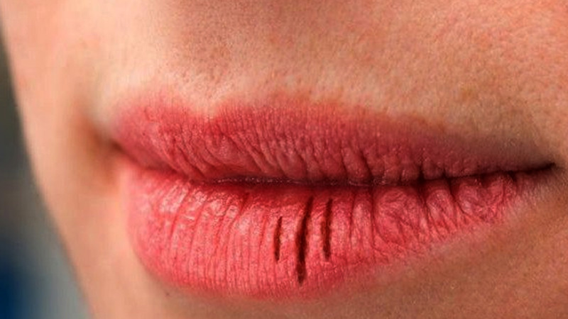 dudak-çatlaması (3)