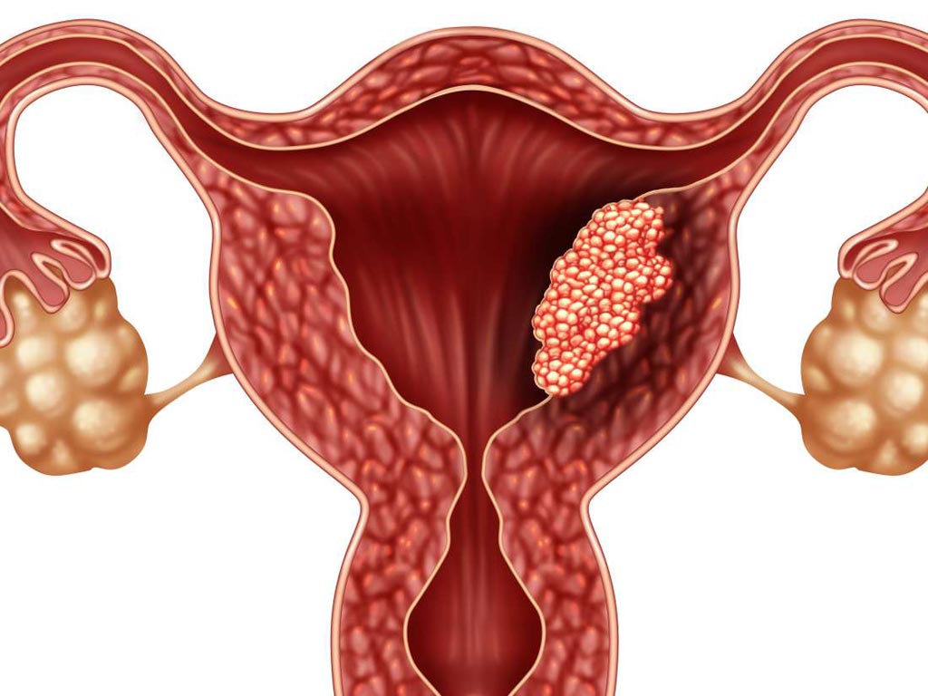Endometrium Kanser 