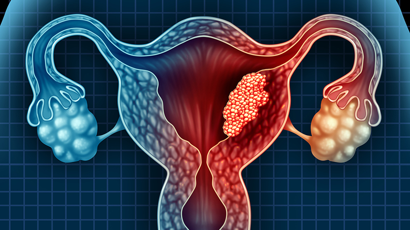 Endometrium Kanser 